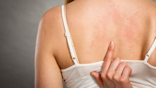 Egzamaya ne iyi gelir? Egzama nedir?