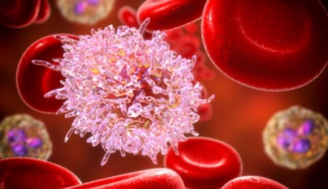Lösemi belirtileri nelerdir? Lösemi hastalığını nedenleri nelerdir?
