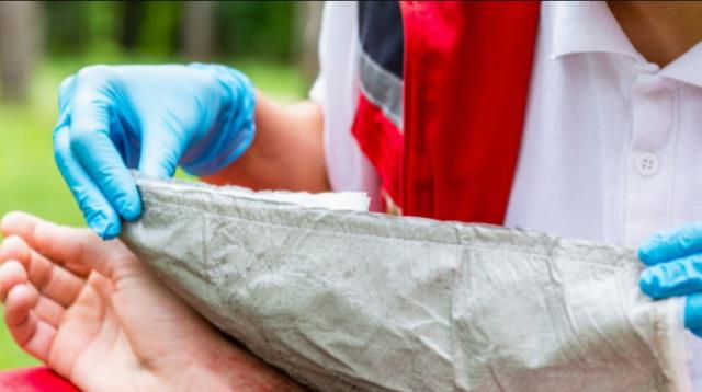 Yanığa ne iyi gelir? Yanık dereceleri nelerdir?