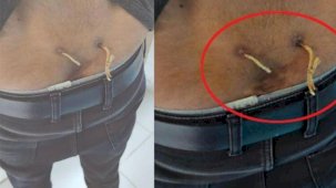 'Alternatif tıp' adı altında işkence: Deri altından çamaşır ipi geçirmişler