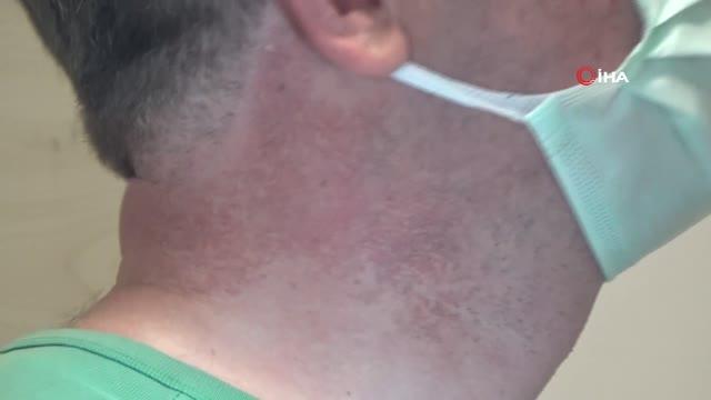 Uzmanlar güneş alerjisine karşı uyardı