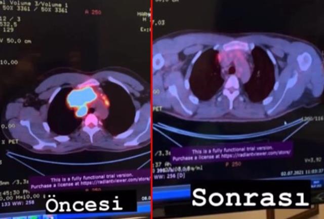Kansere yakalanan oyuncu Boğaç Aksoy'dan öncesi-sonrası paylaşımı: Tedavimiz harika gidiyor