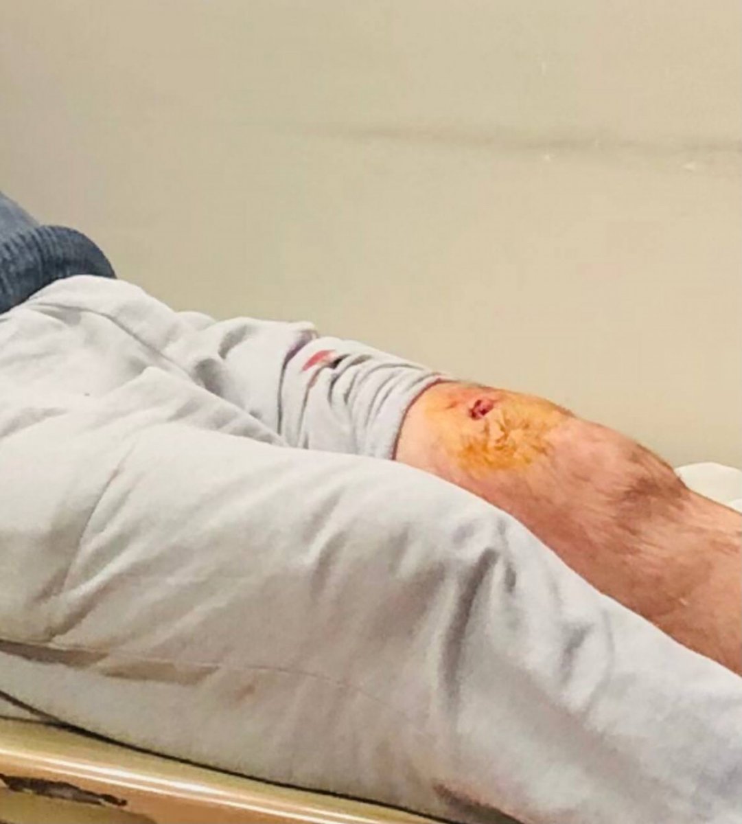 Artvin'de evinin önünde ayı saldırısına uğrayan adam yaralandı