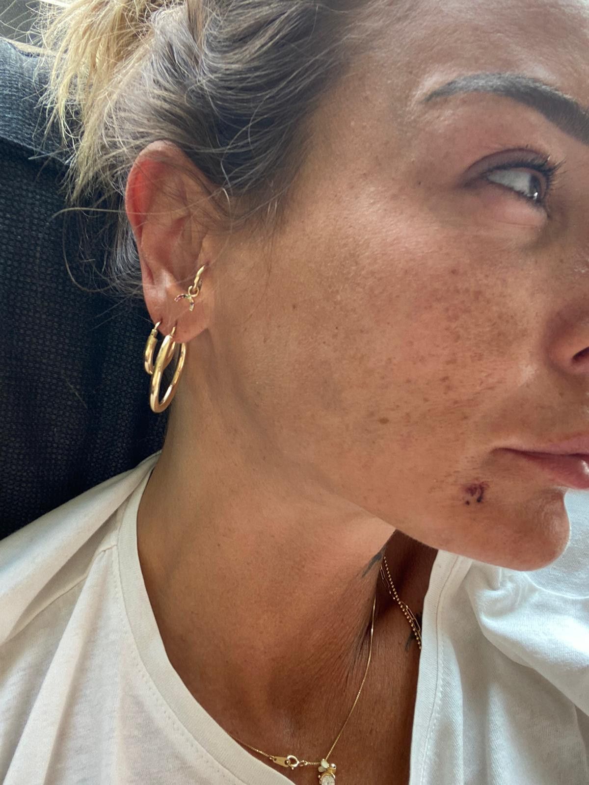 Bursa'daki kadın uzaklaştırma kararı aldırdığı eski sevgilisi tarafından darbedildi