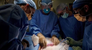 Herkesin gözü bu ameliyattaydı! İşte domuz böbreğinin ölü insana nakil işleminin ilk sonuçları