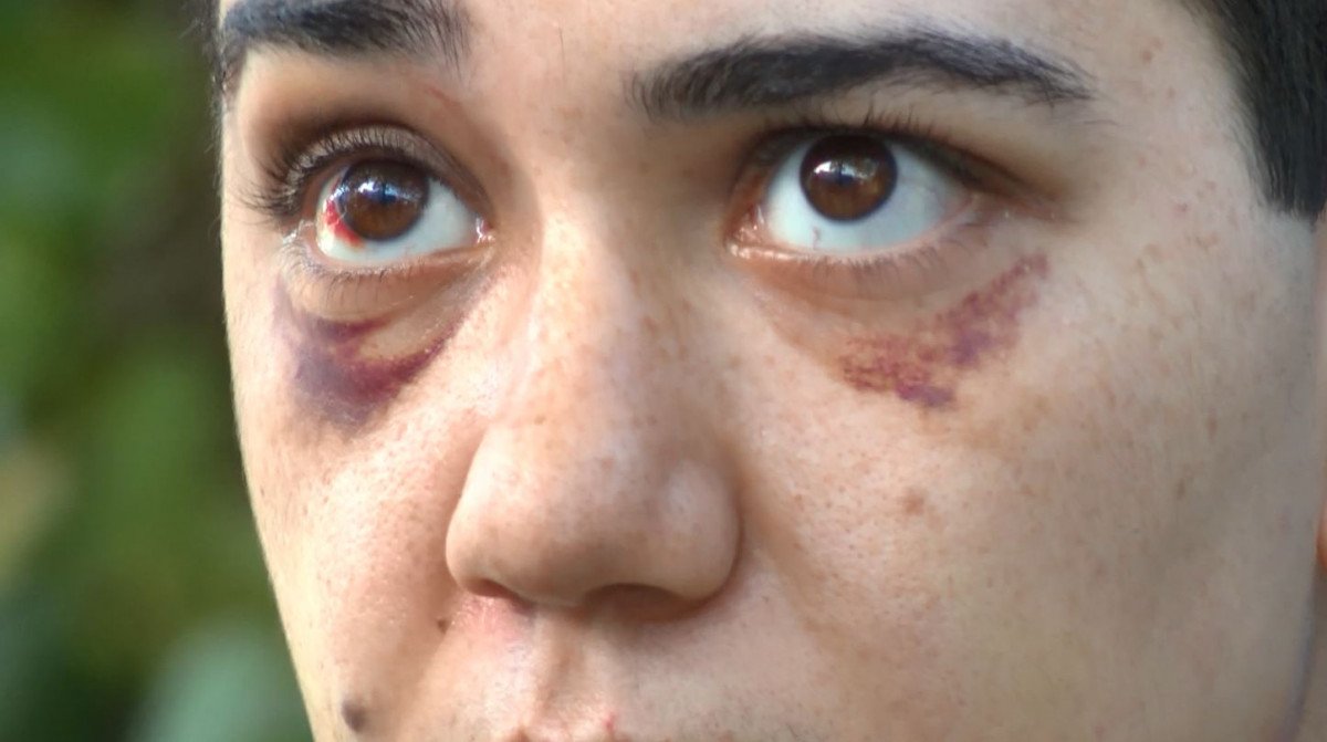 Beyoğlu'nda saldırı sonrası yüzü kısmi felç oldu