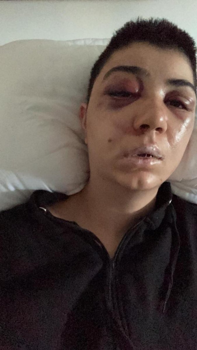 Beyoğlu'nda saldırı sonrası yüzü kısmi felç oldu