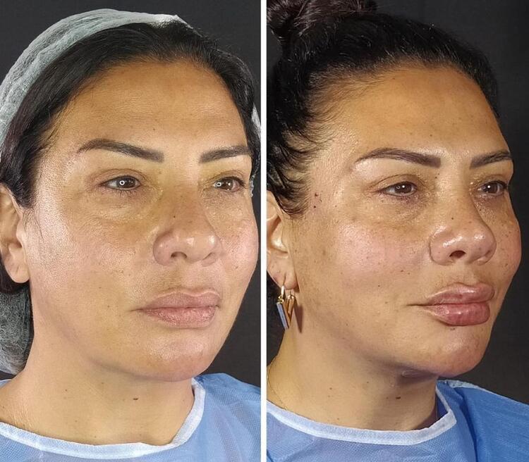 Demet Özdemir'den iddialara yanıt: Bugün estetiği fazla kaçırdım