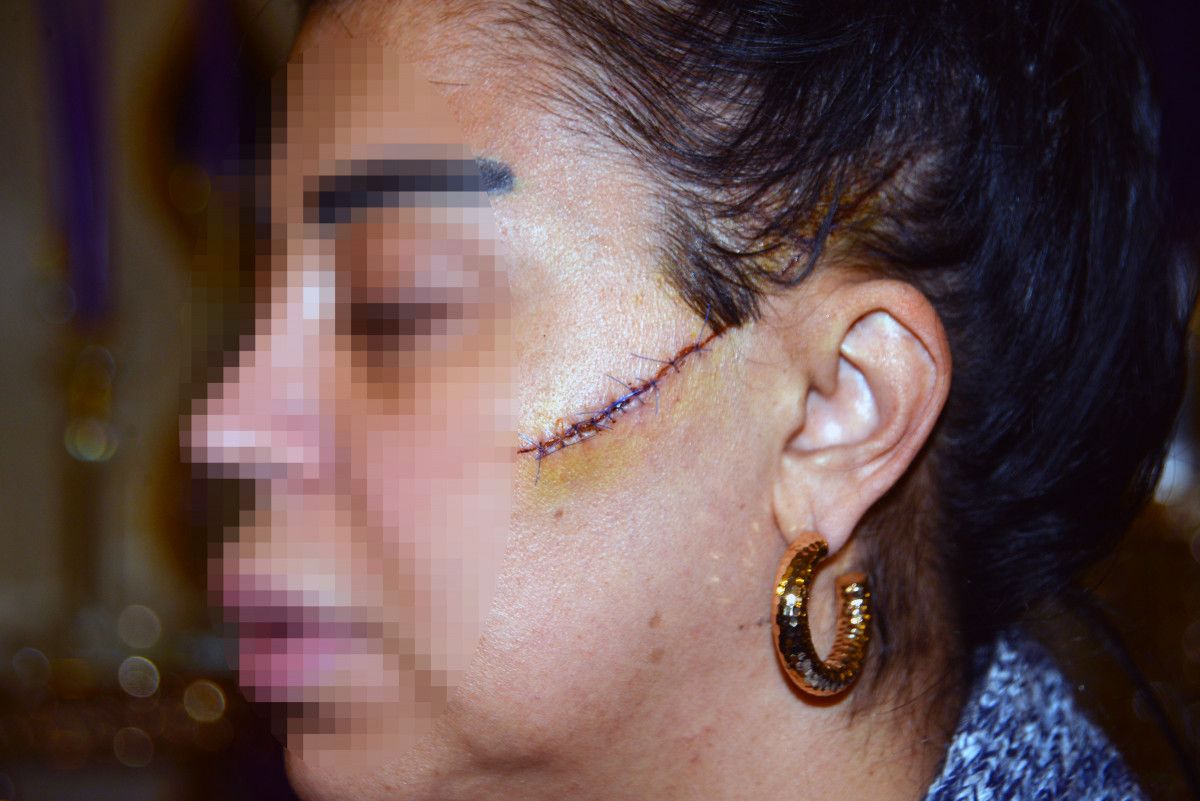 Adana'da eski sevgilisi, bu kez de yüzünü usturayla kesti