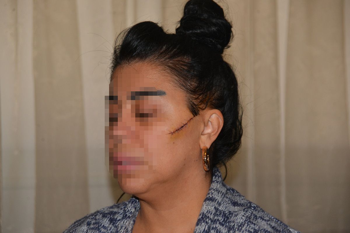 Adana'da eski sevgilisi, bu kez de yüzünü usturayla kesti