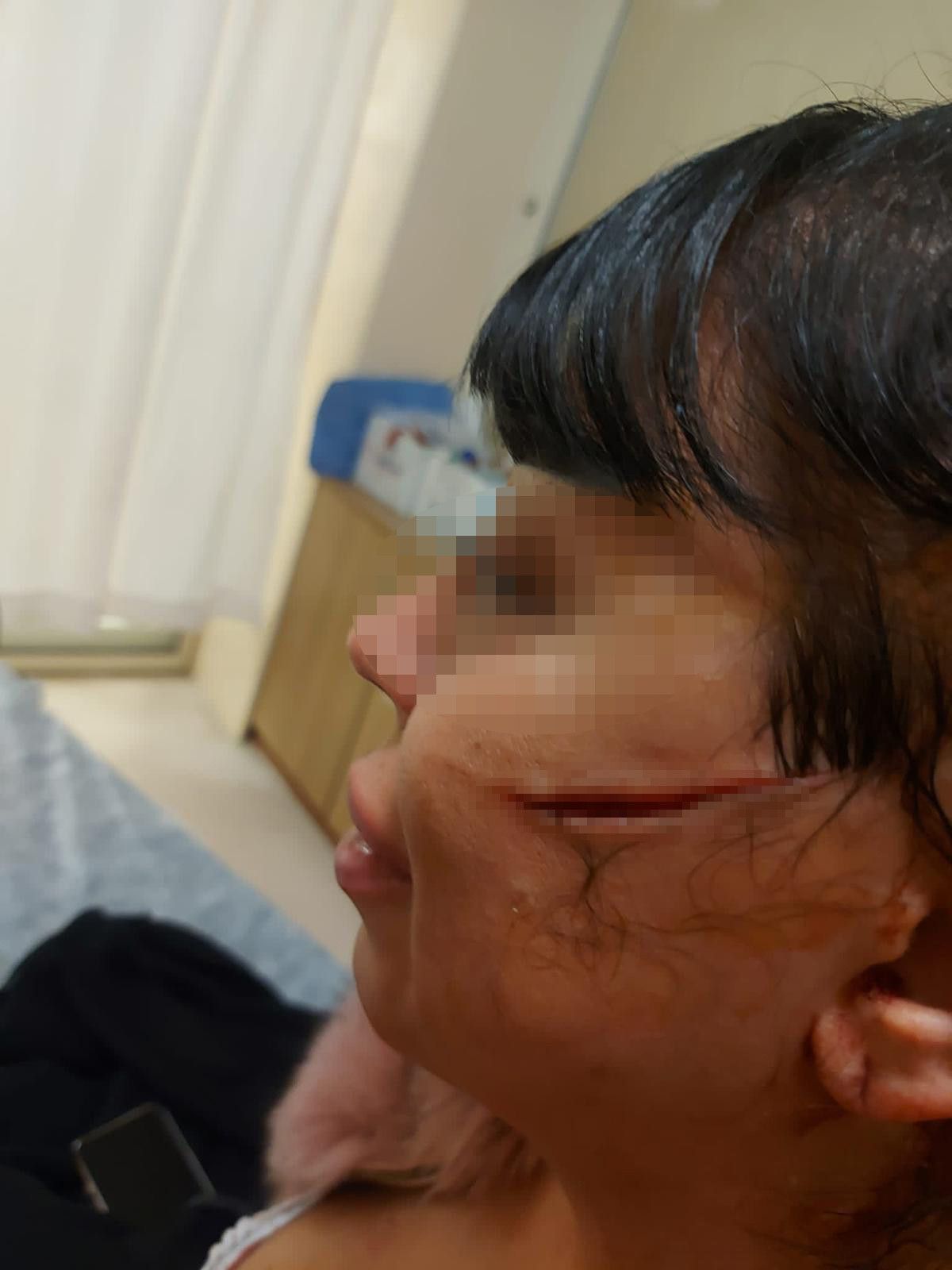 Adana'da eski sevgilisi, bu kez de yüzünü usturayla kesti