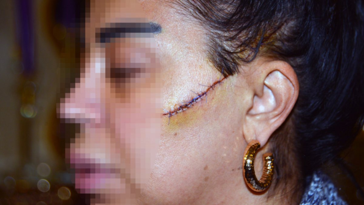 Adana'da eski sevgilisi, bu kez de yüzünü usturayla kesti