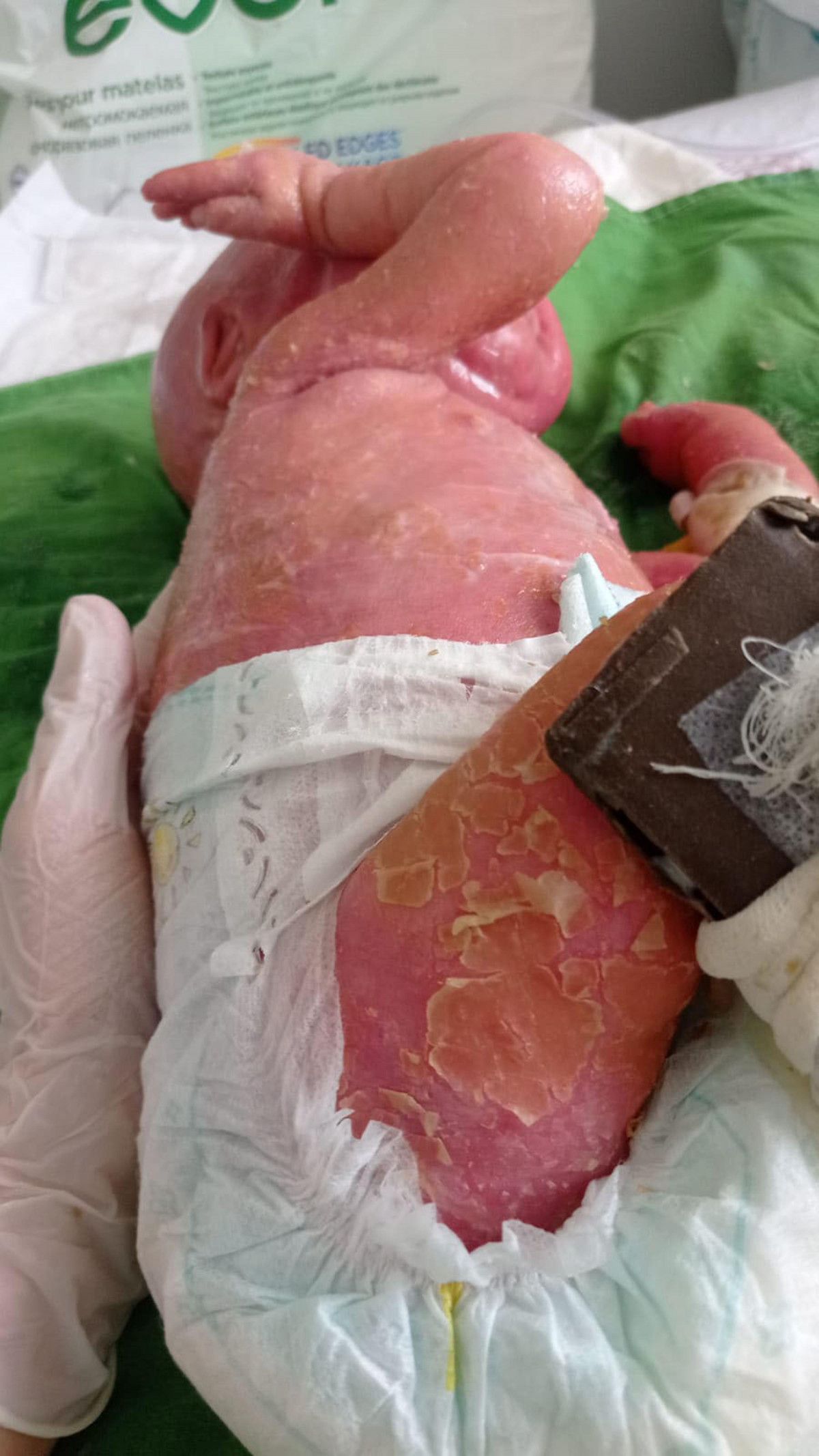 Palyaço Bebek Sendromu ile dünyaya gelen Gökdeniz 1 yaşında