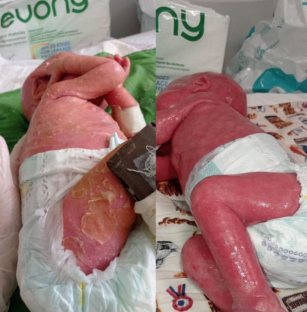 Palyaço Bebek Sendromu ile dünyaya gelen Gökdeniz 1 yaşında