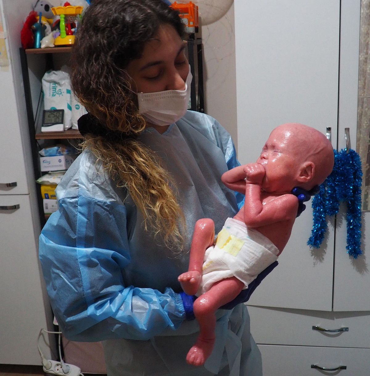 Palyaço Bebek Sendromu ile dünyaya gelen Gökdeniz 1 yaşında