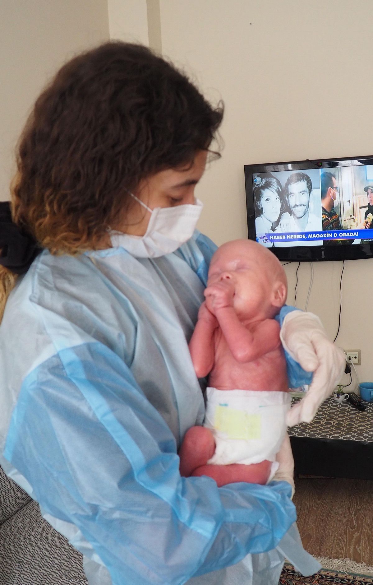 Palyaço Bebek Sendromu ile dünyaya gelen Gökdeniz 1 yaşında