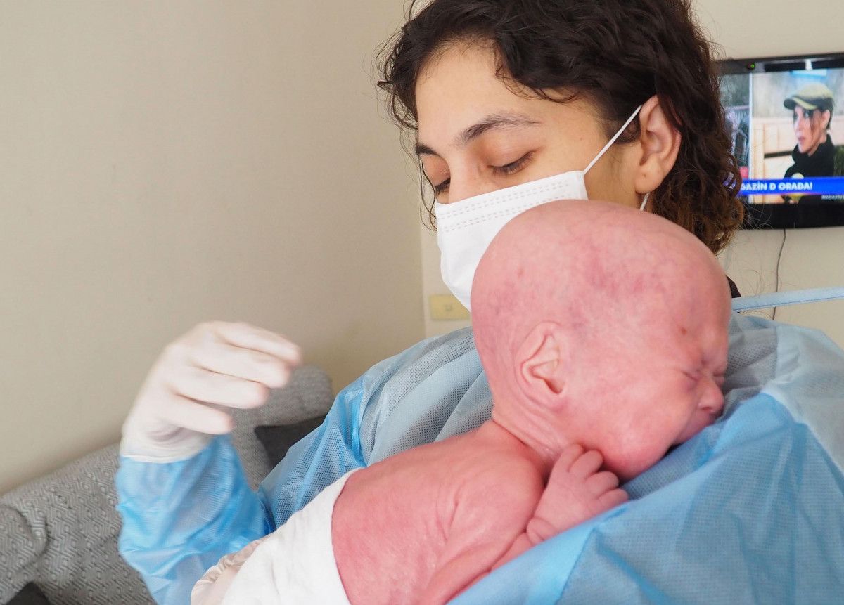 Palyaço Bebek Sendromu ile dünyaya gelen Gökdeniz 1 yaşında