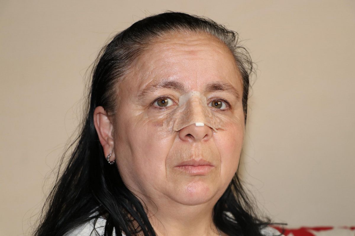 Eskişehir'de birlikte yaşadığı sevgilisi burnunu kırdı