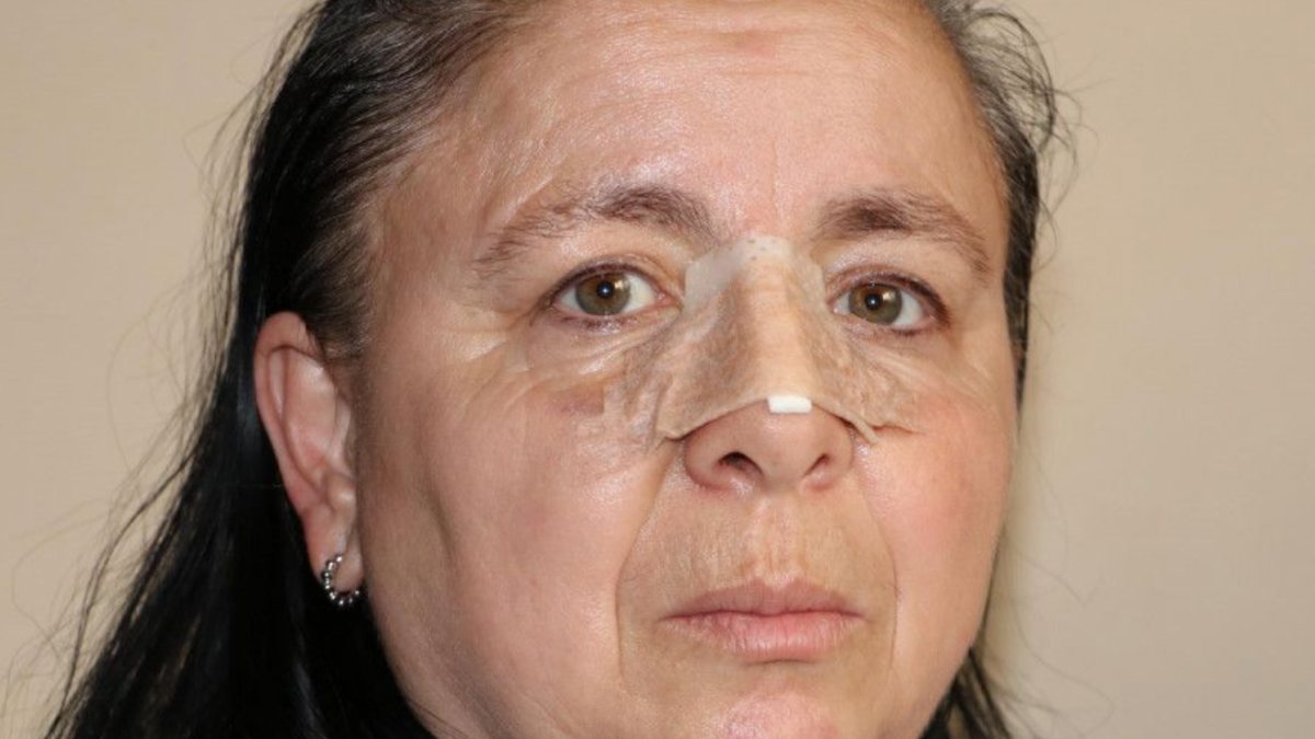 Eskişehir&#039;de birlikte yaşadığı sevgilisi burnunu kırdı