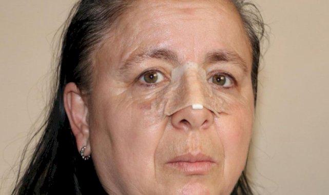 Eskişehir'de birlikte yaşadığı sevgilisi burnunu kırdı