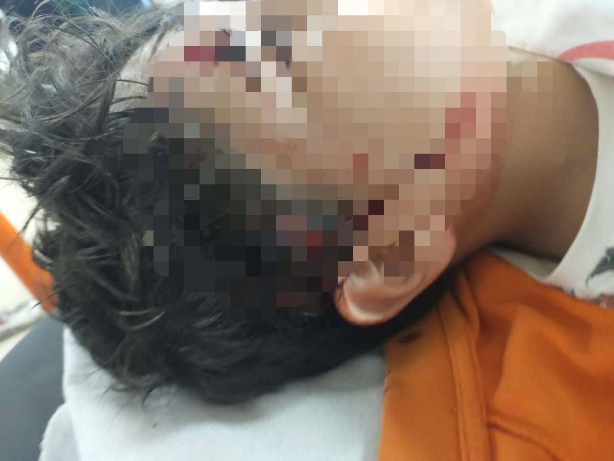 Bursa'da 8 köpeğin saldırısına uğrayan çocuğa 80 dikiş atıldı