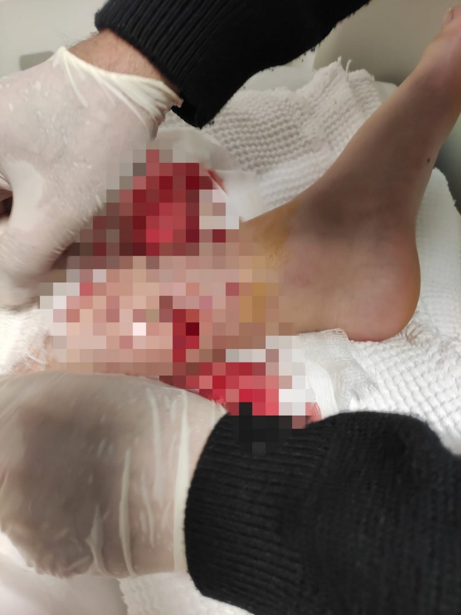 Bursa'da 8 köpeğin saldırısına uğrayan çocuğa 80 dikiş atıldı