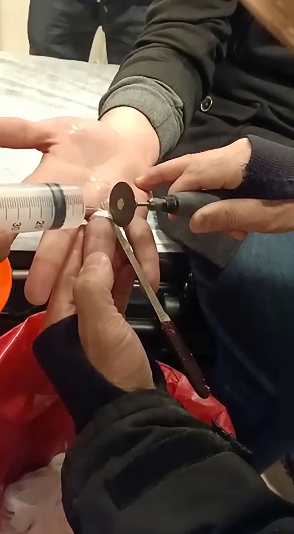 Erzurum'da acil servis, yüzüğü çıkmayan adam için seferber oldu