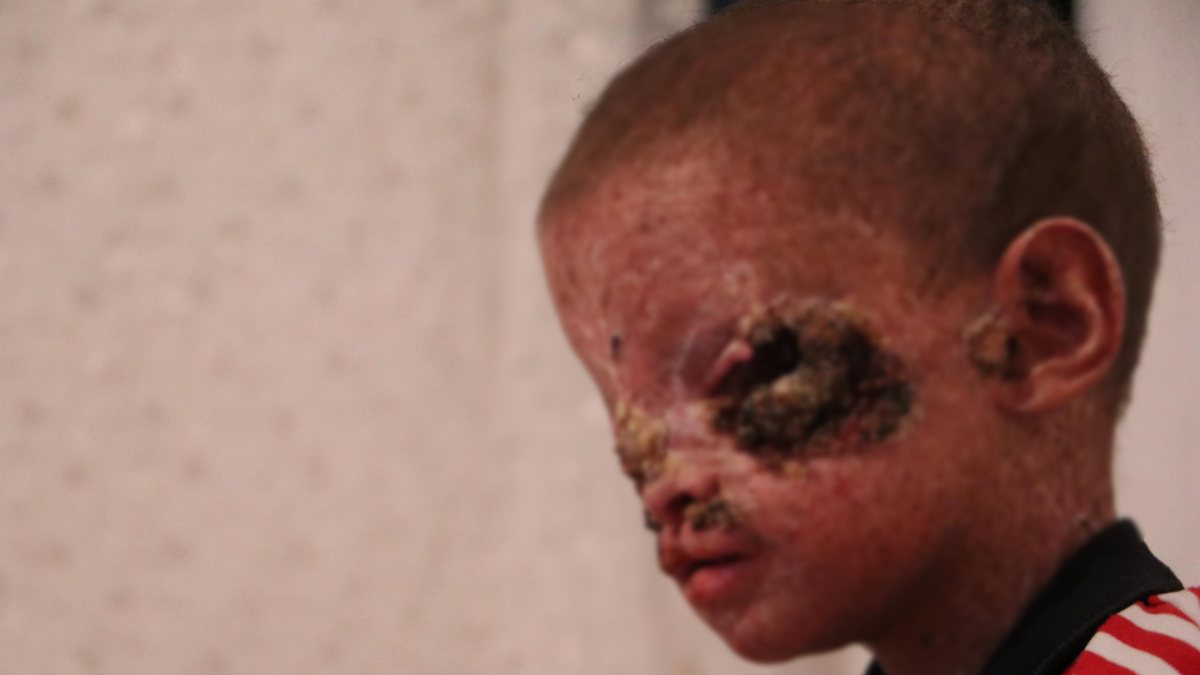 Erzurum&#039;da cilt kanserinden gözleri kapanan Salih: Ailemi görmek istiyorum