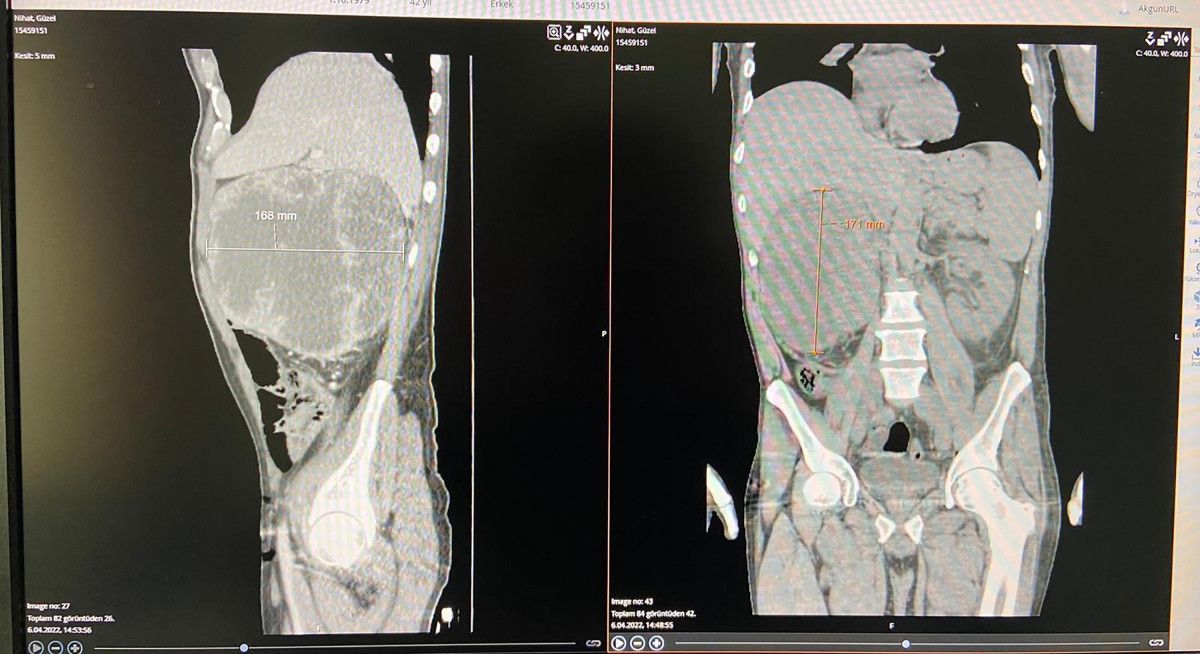 Erzurum'da halsizlik nedeniyle doktora giden adamın karnından kitle çıktı
