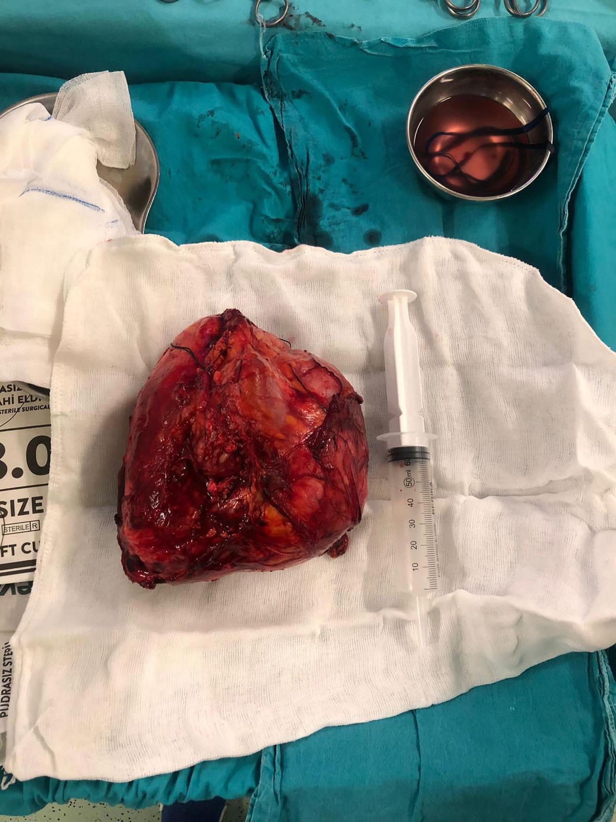 Erzurum'da halsizlik nedeniyle doktora giden adamın karnından kitle çıktı