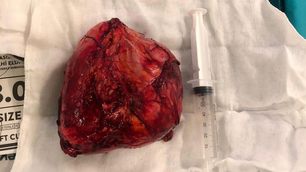 Erzurum&#039;da halsizlik nedeniyle doktora giden adamın karnından kitle çıktı