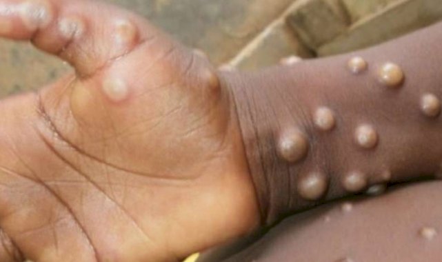 Dünya Sağlık Örgütü, maymun çiçeği virüsü vakalarını doğruladı