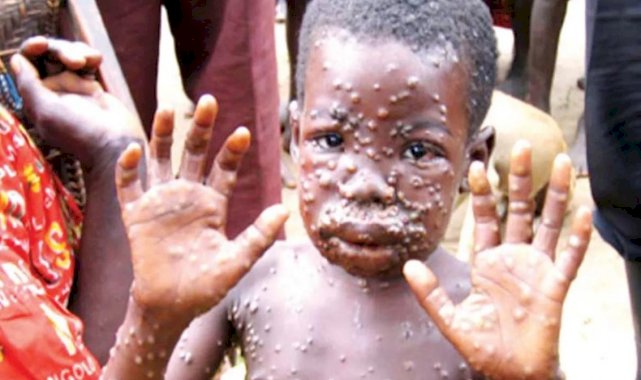 Maymun çiçeği virüsü yayılıyor: 5 ülkede görüldü