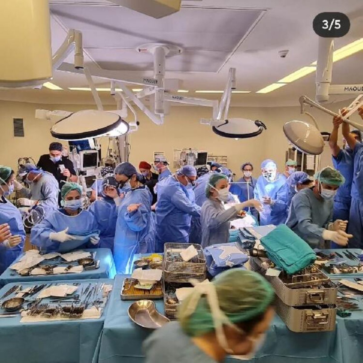 Cezayirli siyam ikizleri İstabul'da ayrıldı