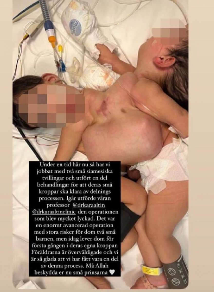 Cezayirli siyam ikizleri İstabul'da ayrıldı