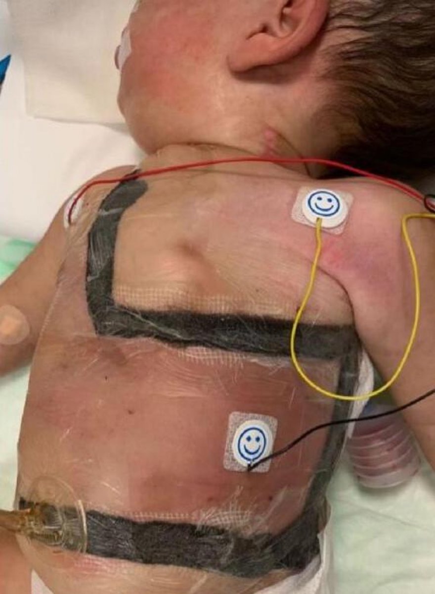 Cezayirli siyam ikizleri İstabul'da ayrıldı