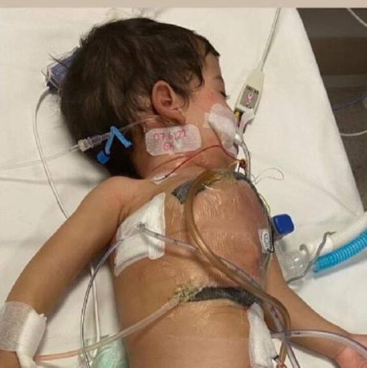 Cezayirli siyam ikizleri İstabul'da ayrıldı