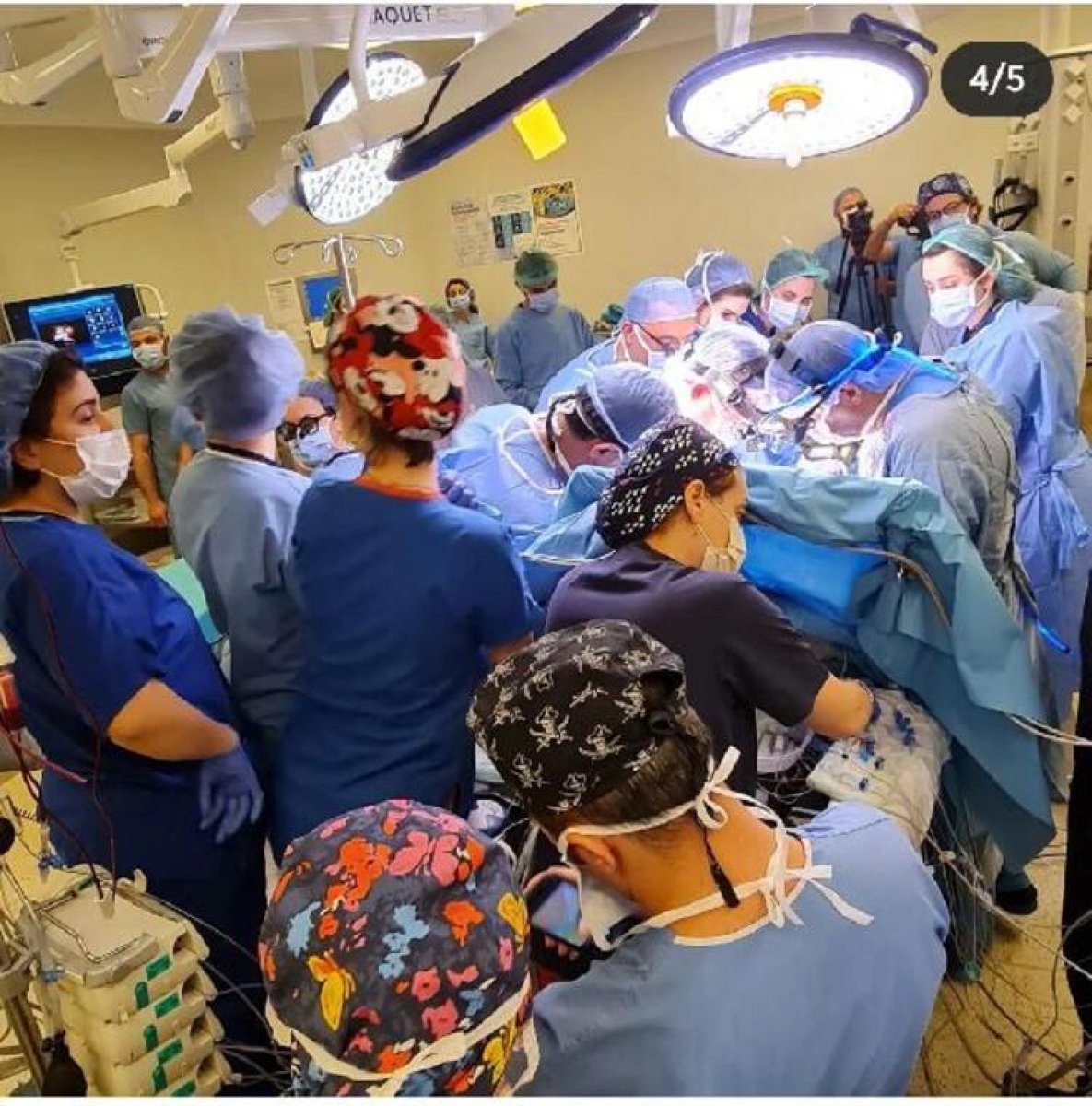 Cezayirli siyam ikizleri İstabul'da ayrıldı