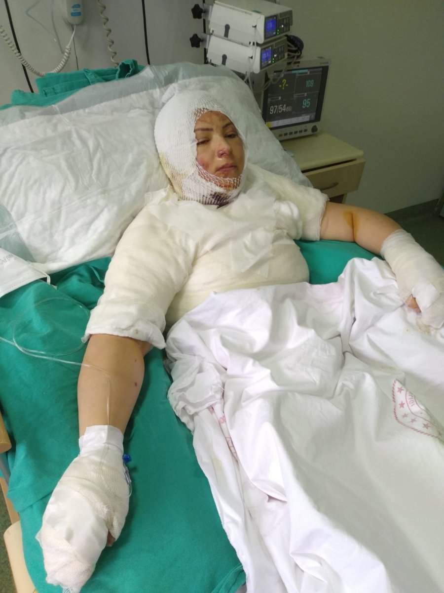 Ordu’da eski eşi tarafından yakılan kadın: Mangal yanıyormuş gibi izledi
