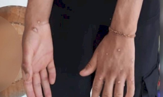 Sultangazi'de maymun çiçeği şüphesi