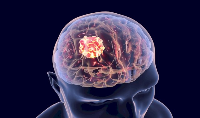 Beyin Hastalıklarında Dil ve Konuşma Nasıl Etkilenir ?