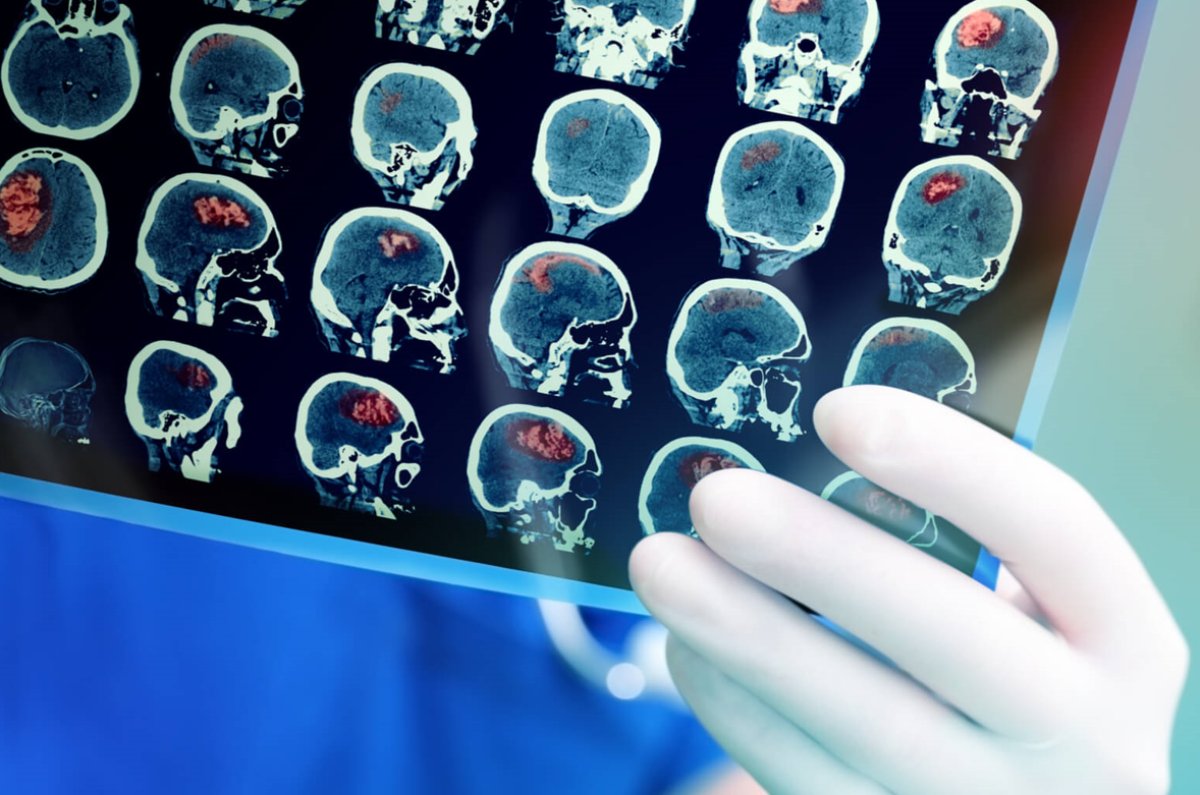 Prof. Dr. Aziz Sancar'dan beyin kanserine umut olacak keşif