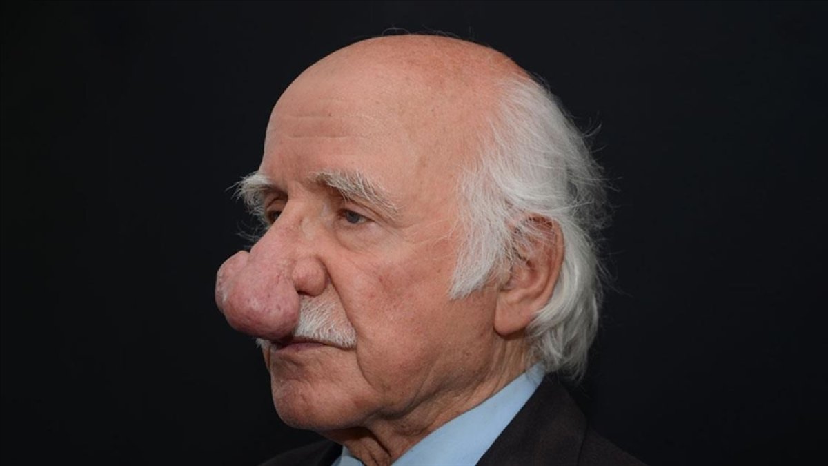 Trabzon'da burnundaki dev kitleyle 2 yıl yaşayan hasta ameliyatla kurtuldu