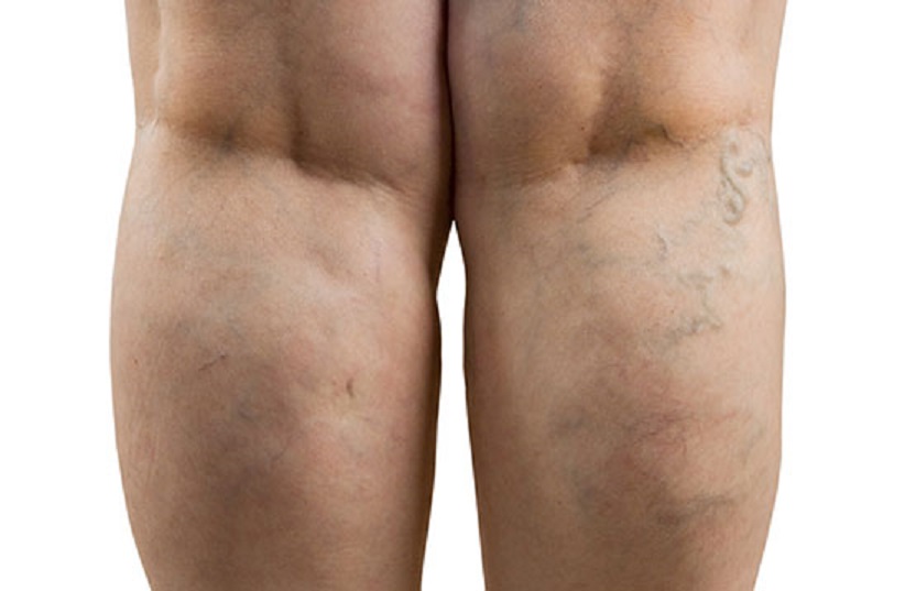 Varis Hastalığında Genetik Özellikler Riski Artırıyor