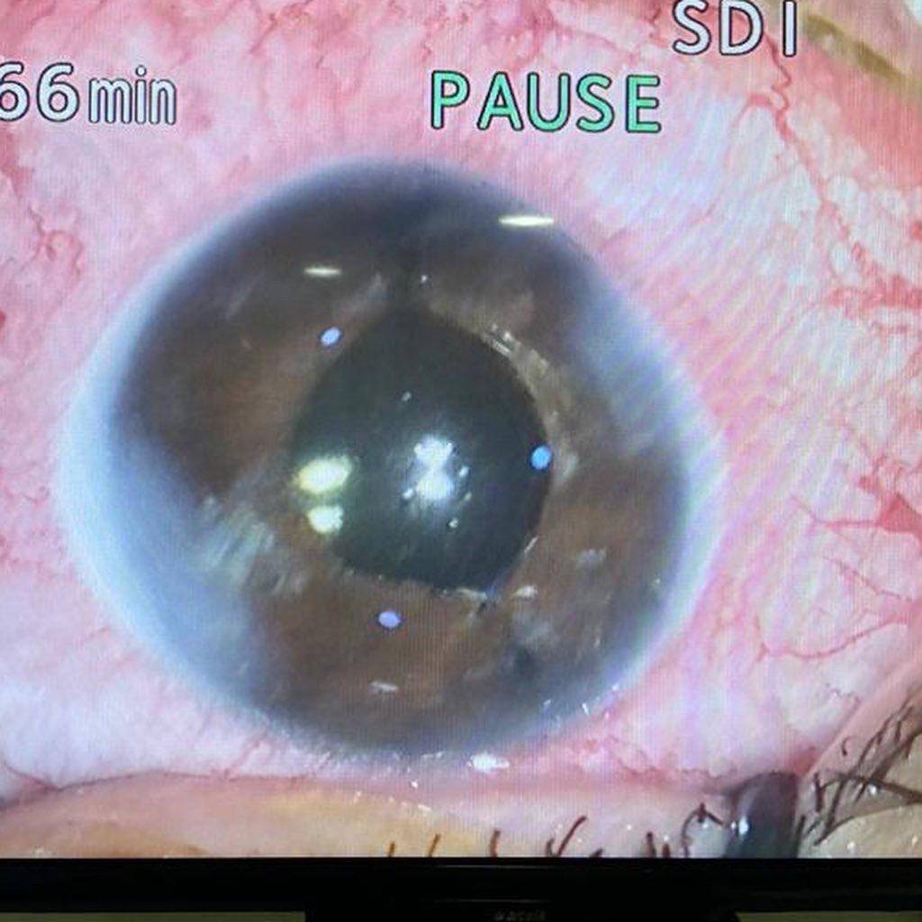 Göz Bebekleri Yere Bakan Gurbetçi İzmir’de Sağlığına Kavuştu