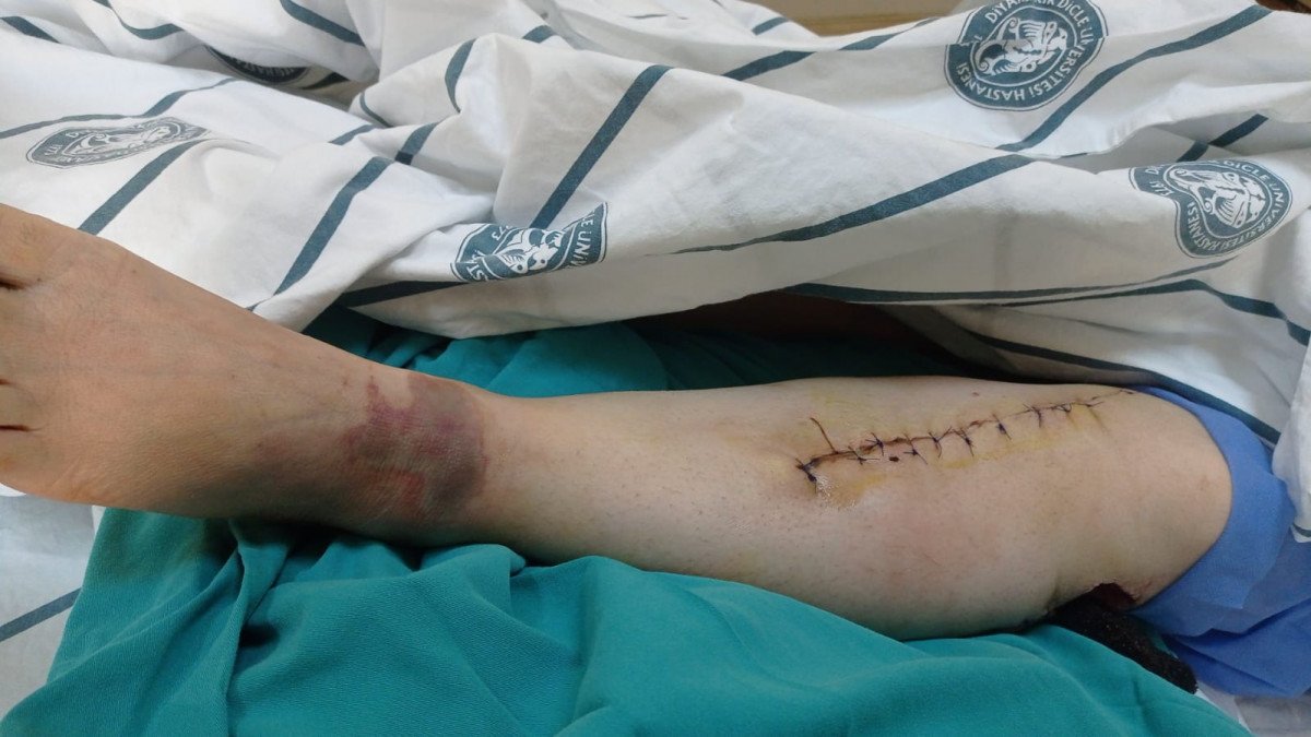 Oğlu tarafından pompalı tüfekle vurulan anne, kangren riski ile karşı karşıya