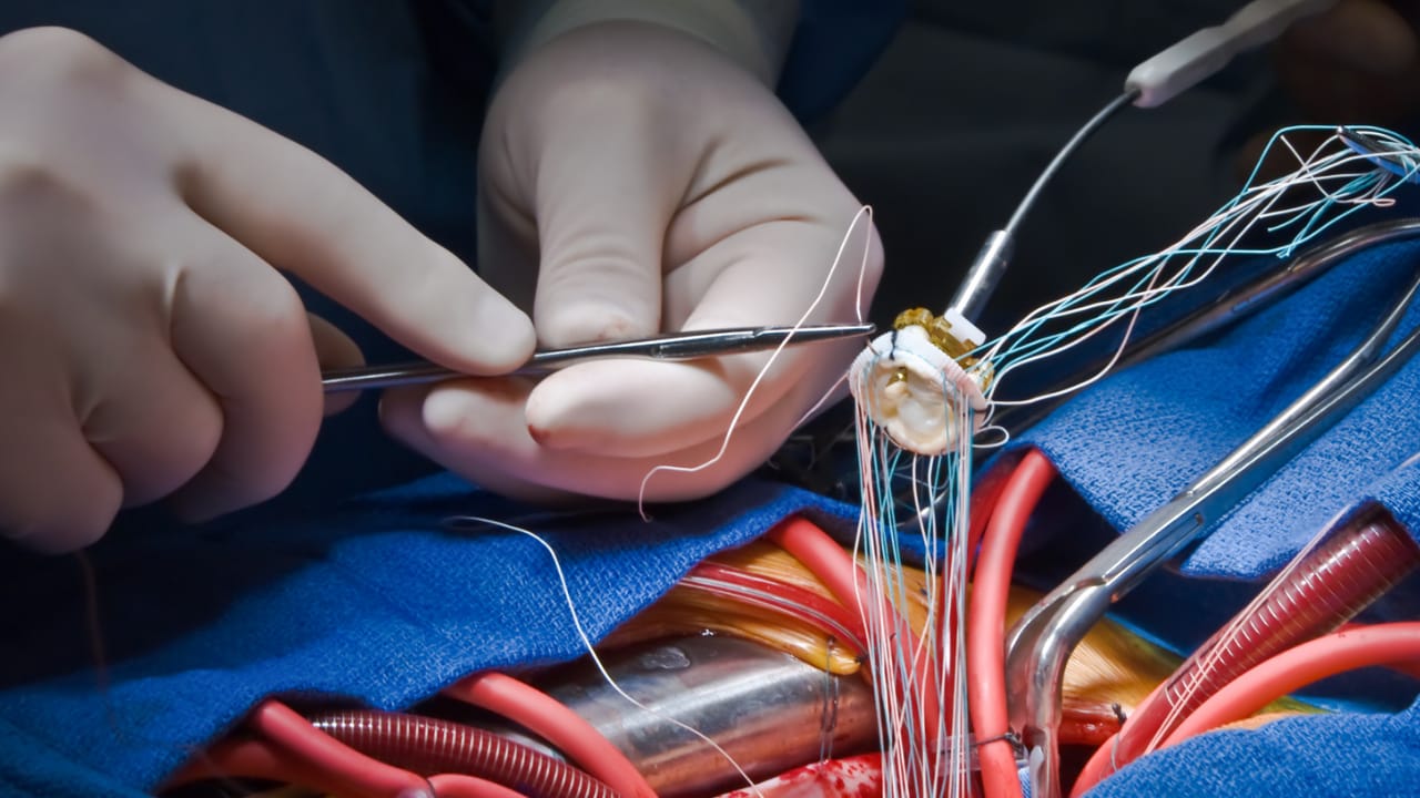 4 Kişiden Birinin Ölüm Sebebi Tromboz