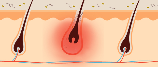 Sivilceniz HS Hastalığı Belirtisi Olabilir !