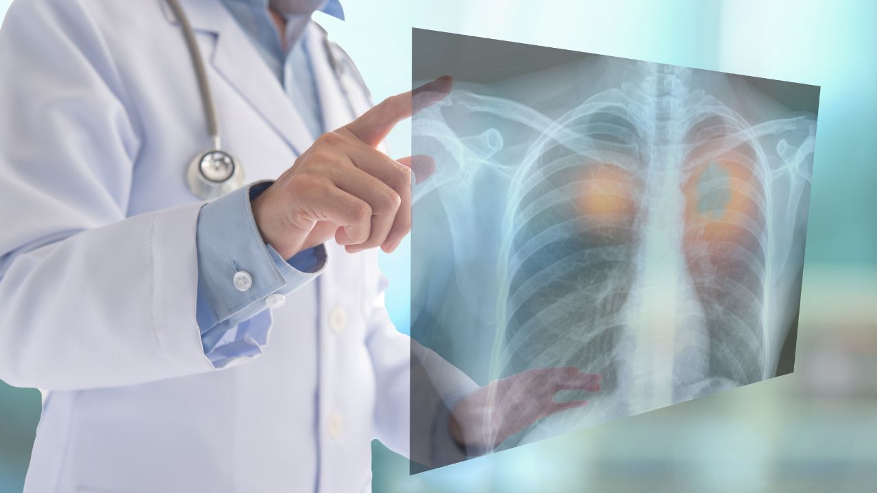 Erkeklerde Akciğer, Kadınlarda Meme Kanseri İlk Sırada