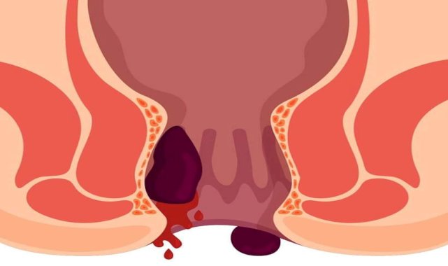 Oturarak Çalışmak hemoroid Sebebi